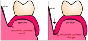 chirurgie osseuse5