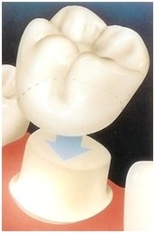 prothèse fixée